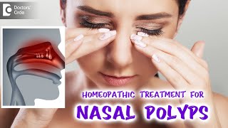 NASAL POLYPS Causes SIgns and Symptoms Diagnosis and Treatment [upl. by Ecined]