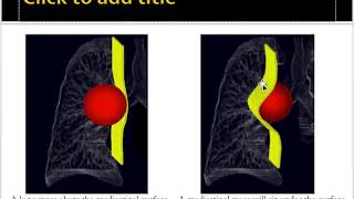 Mediastinal masses approach [upl. by Lorine180]