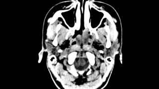 Solving Nasal Drainage Issues [upl. by Burg]