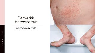 Dermatitis Herpetiformis [upl. by Ysac32]