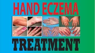 DyshidrosisDyshidrotic eczemaHand eczemaPompholyx treatment [upl. by Miguelita630]