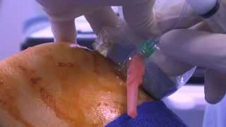 WATCH a Knee Joint Injection  LIVE [upl. by Atterrol]