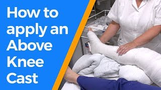 How to apply an Above Knee Cast [upl. by Schreck692]