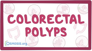 Nasal Polyps diagnosis and treatment options [upl. by Araiek]