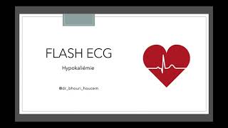 Flash ECG  Hypokaliémie [upl. by Gaskin808]