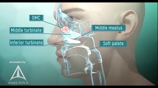 Sinus Polyp Surgery [upl. by Idurt653]