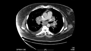 Imaging of Mediastinum Radiological Anatomy  Dr Avni Skandhan MD [upl. by Joshua]